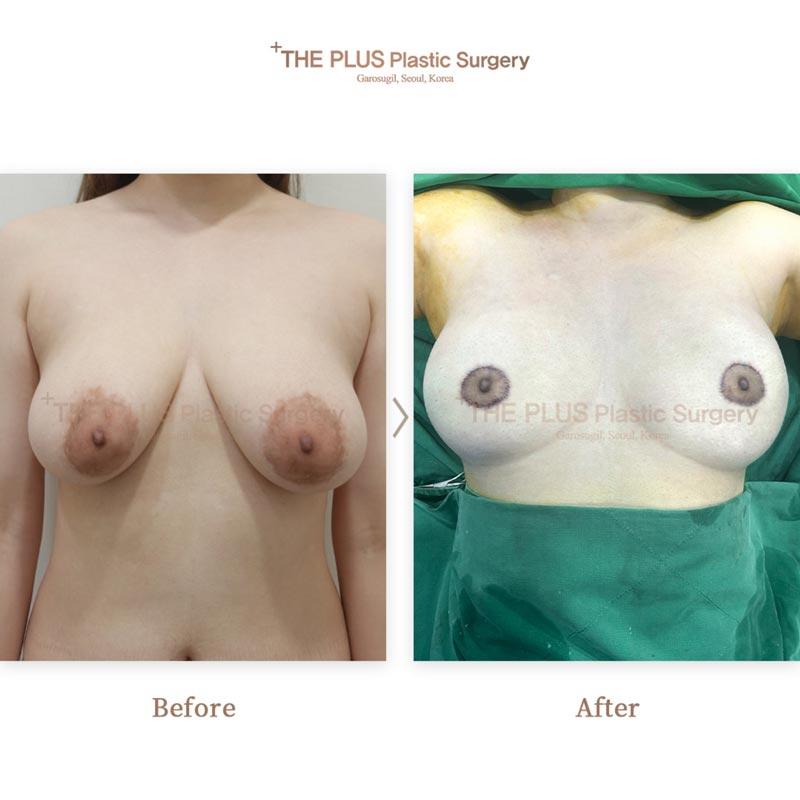 Breast lift with areola reduction