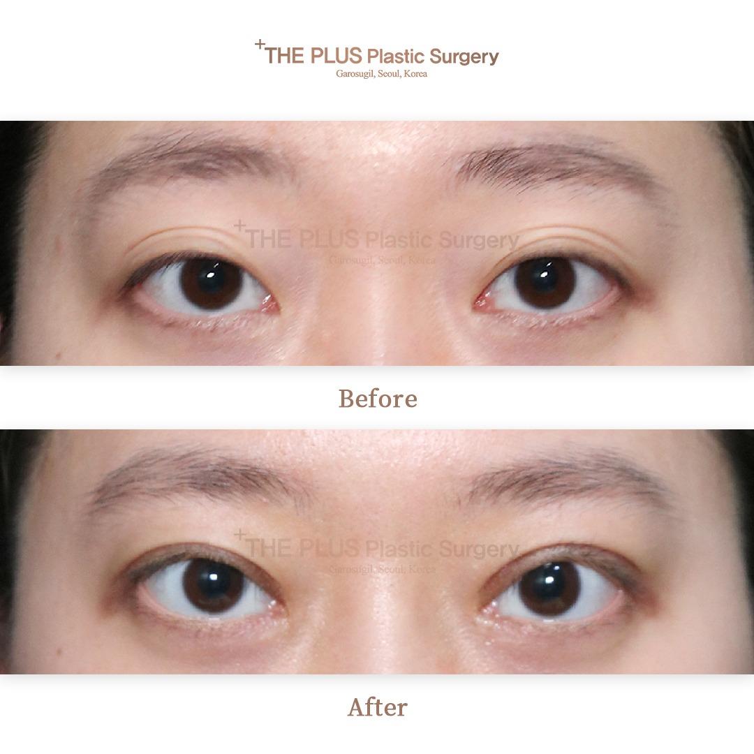 Double eyelid surgery(incisional method)