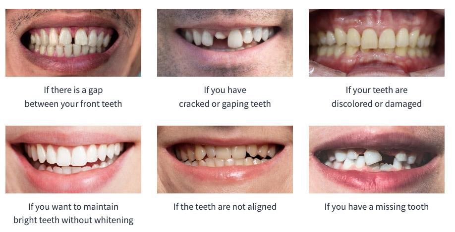 Veneers