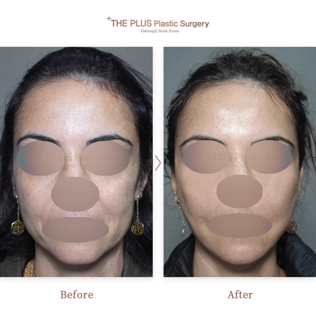 Under Eye Fat Removal + Thread Lifting (Cheeks) + Full Face Contouring