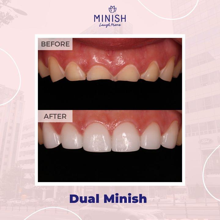 Introducing Dual Minish Veneers - double the protection, double the brilliance. Experience the Minish difference.
