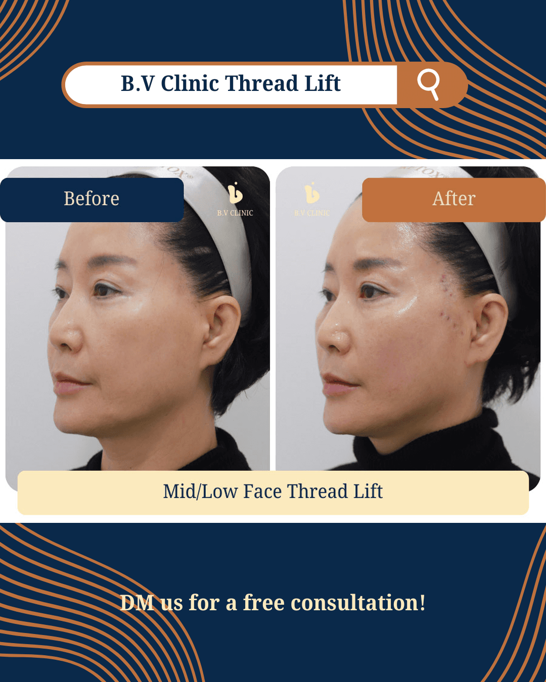 Face Thread Lift