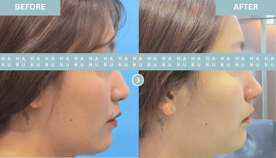 Nose Thread
