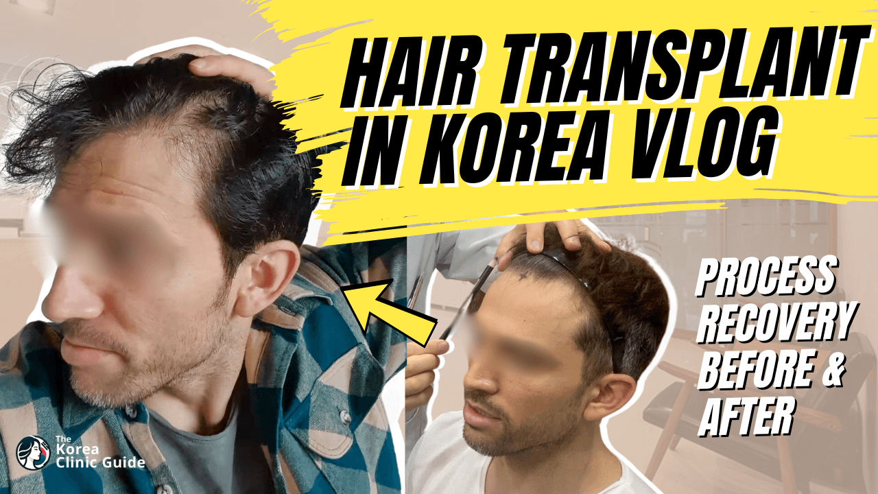 Hair Transplant in Korea Vlog │ Day 1 - 6 Months Recovery Journey at Maxwell Hair Transplant Clinic