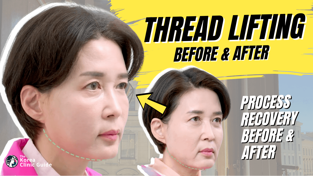 Thread Lifting Before After - PangPang