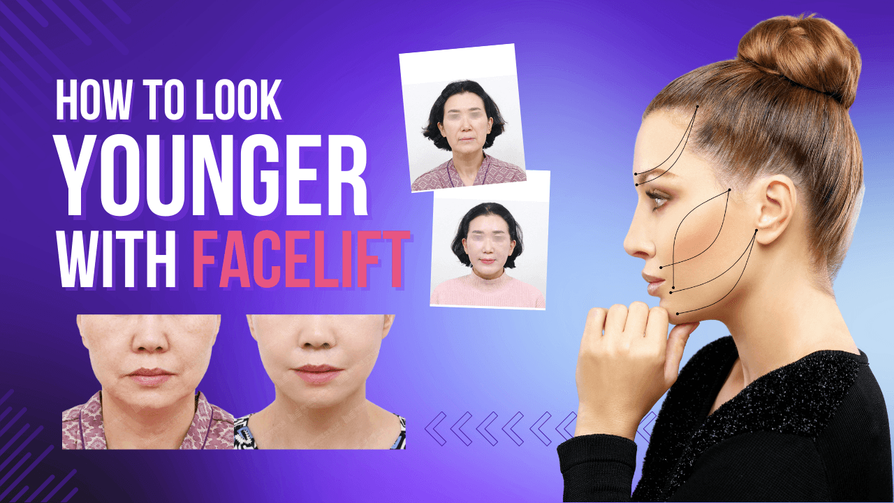 Getting a Facelift in Korea: Cost, Facelift Techniques, Recovery, Benefits & Top Clinics