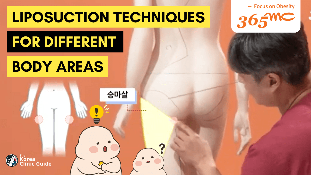Full Body Liposuction in Korea & Liposuction Techniques For Different Body Areas - 365mc Clinic