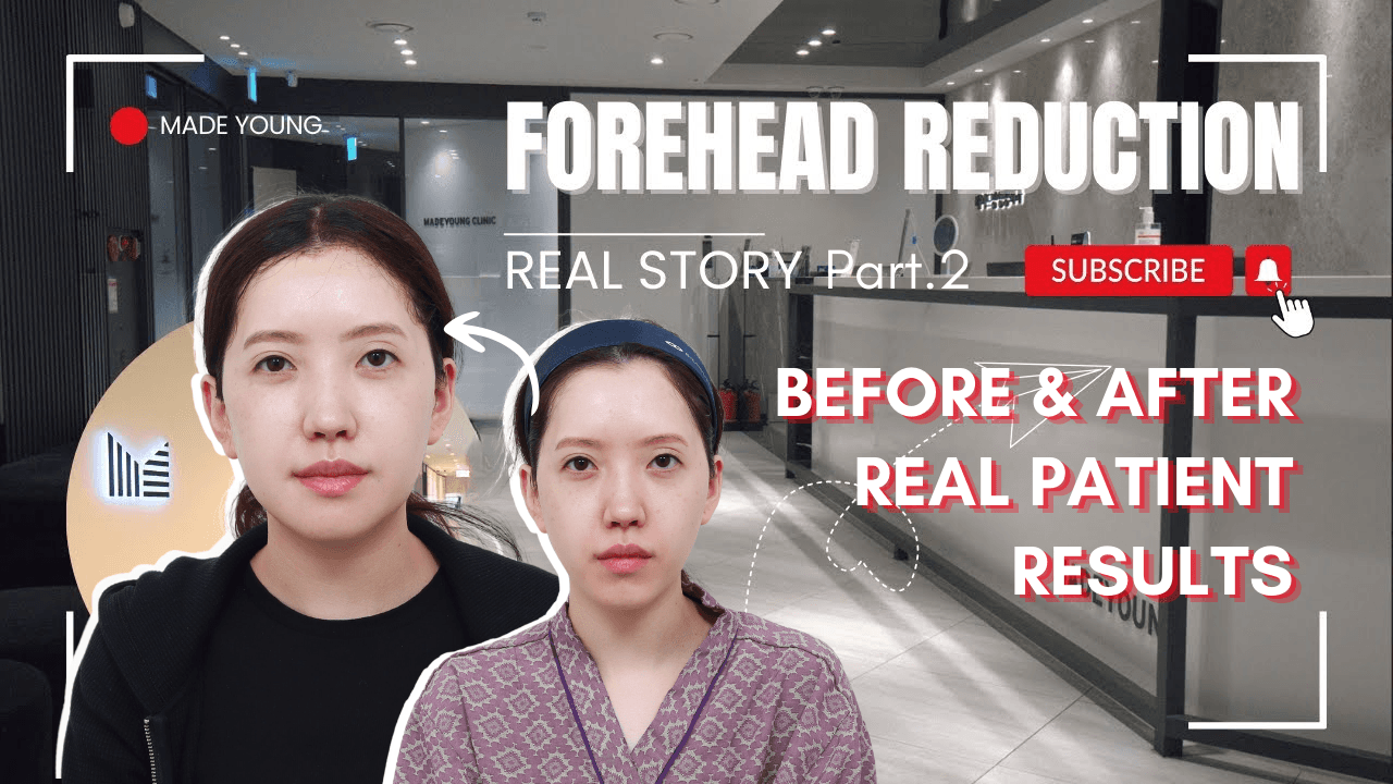 Forehead Reduction pt 2 in Korea Before & After│Real Patient Results From Made Young Clinic in Korea