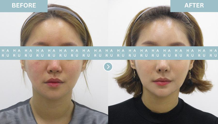 Before and After Chin Botox