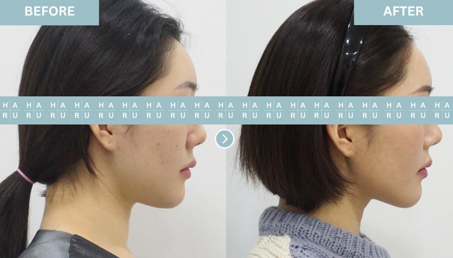 Before and After Face Thread Lift