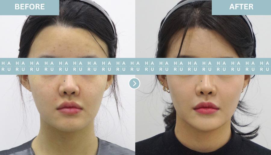 Before and After Chin Botox