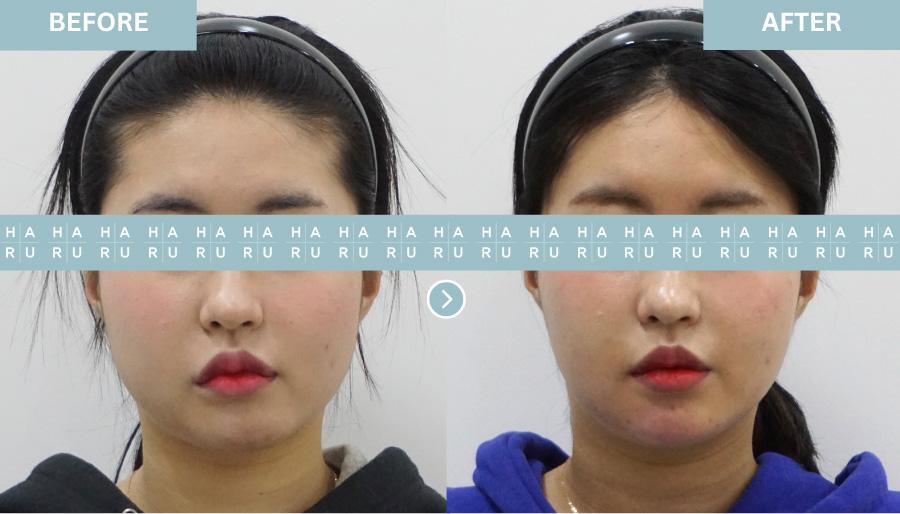 Before and After Chin Botox