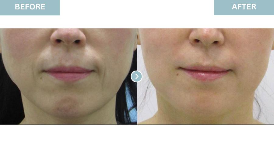 Before and After Collagen Filler