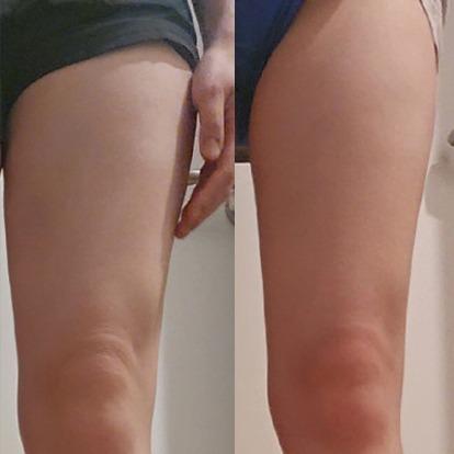 Before and After Fat Dissolving Injection