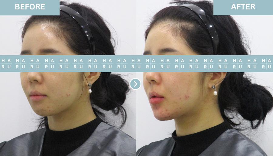 Before and After Chin Botox