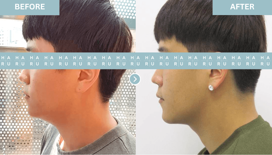 Before and After Face Thread Lift