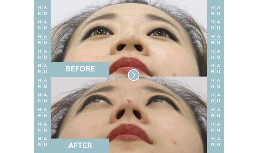 Before and After Hiko Nose Thread Lift