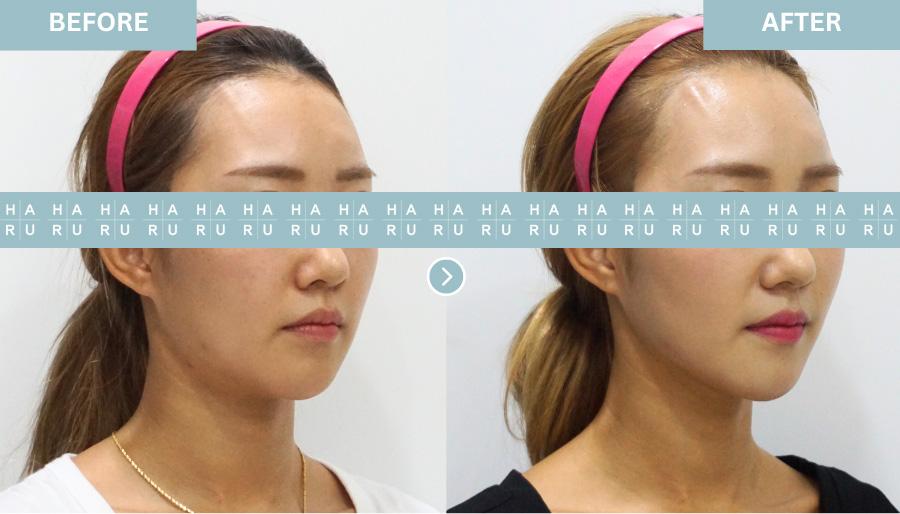 Before and After Face Thread Lift