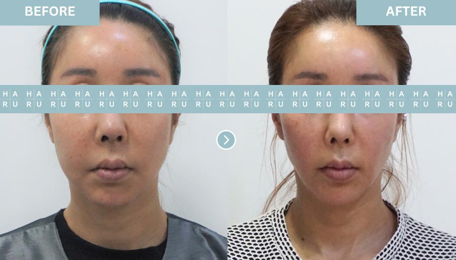 Before and After Face Thread Lift