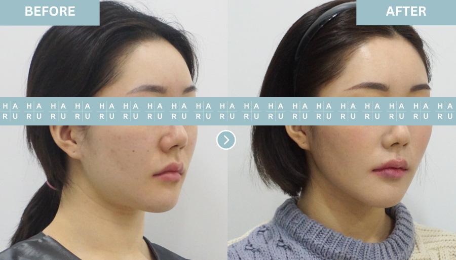 Before and After Face Thread Lift