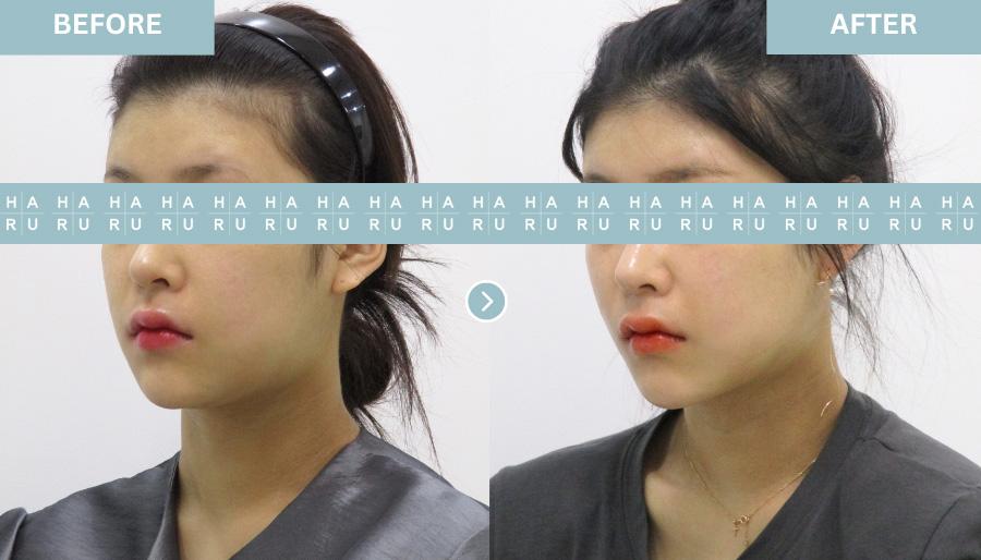 Before and After Face Thread Lift