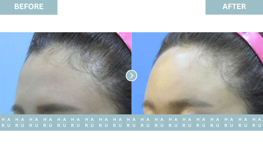 Before and After Forehead Filler