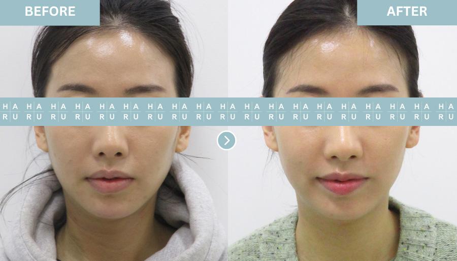 Before and After Lip Fillers