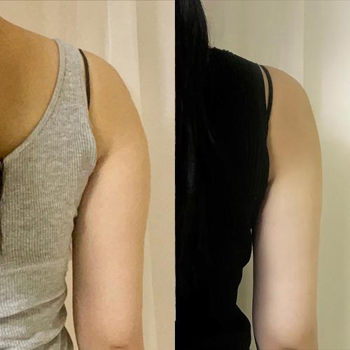 Before and After Fat Dissolving Injection