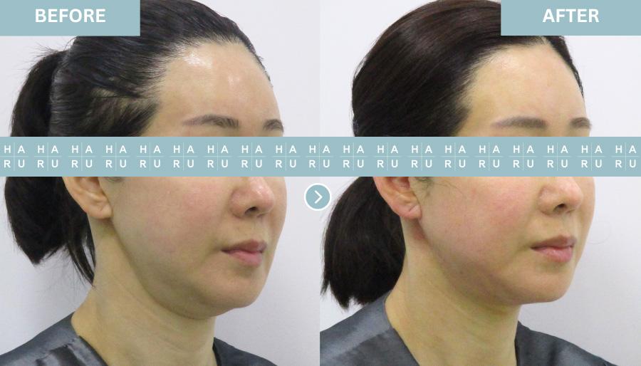 Before and After Double Chin Thread Lift