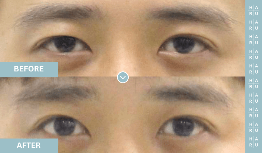 Before and After Eye Thread Lift