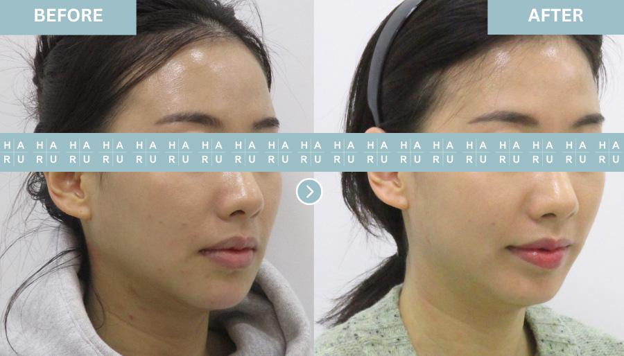 Before and After Lip Fillers