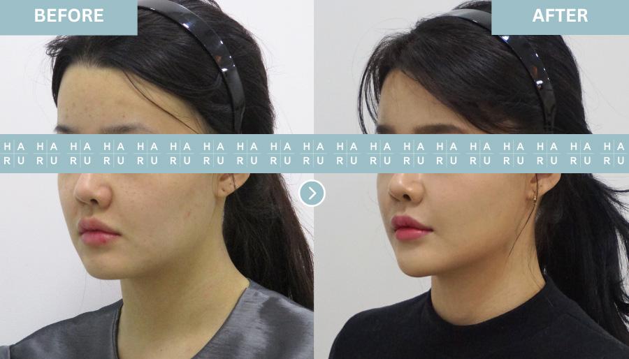 Before and After Chin Botox