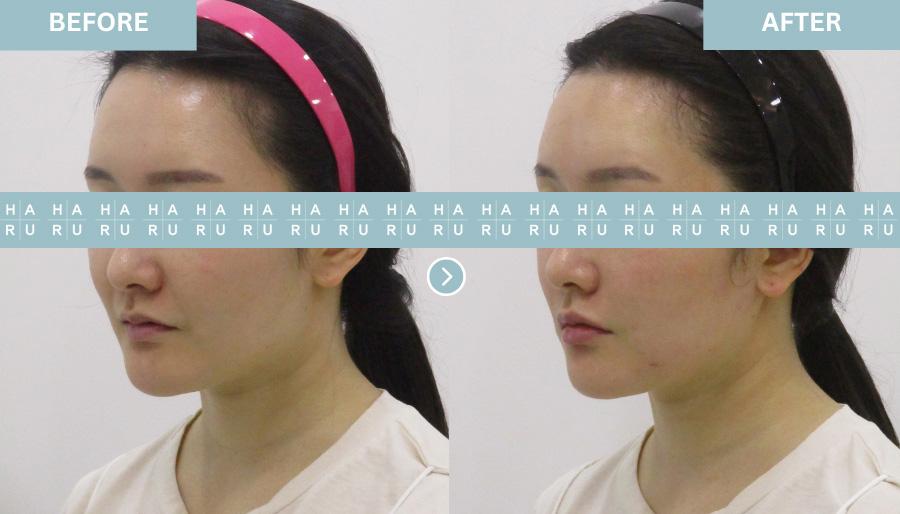 Before and After Lip Fillers