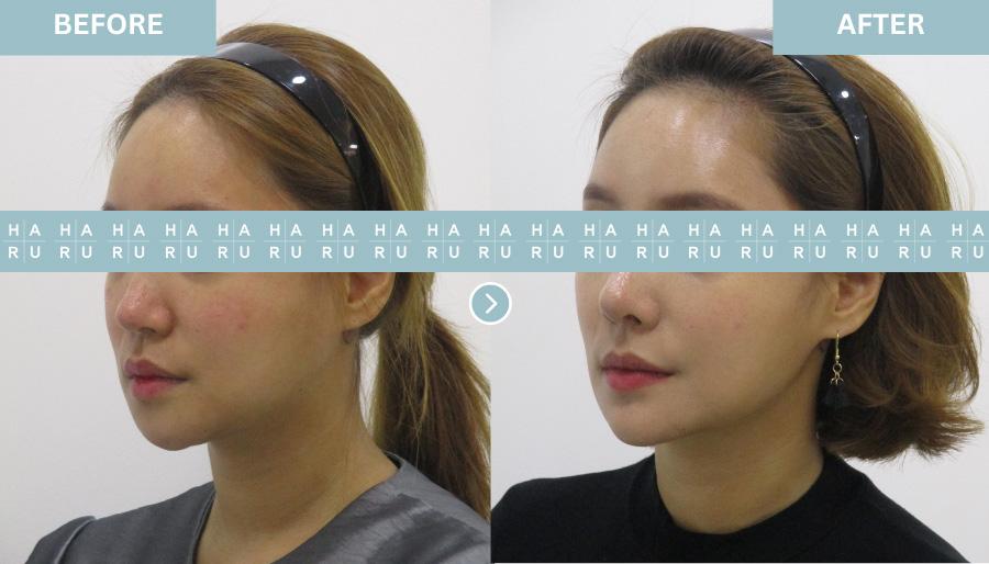 Before and After Chin Botox