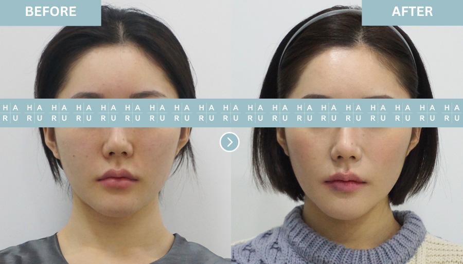 Before and After Face Thread Lift