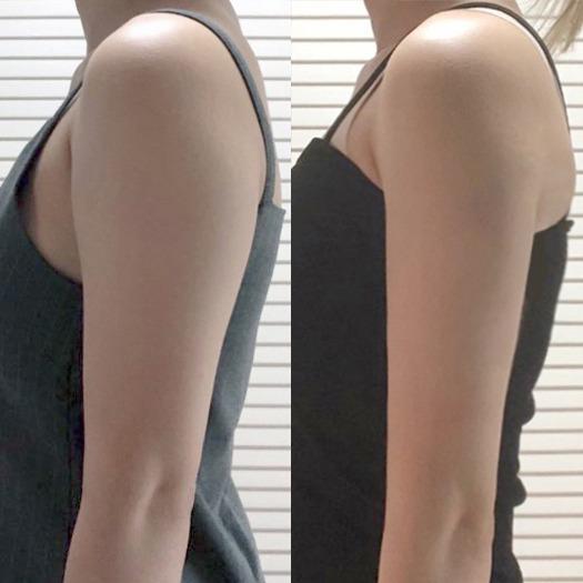 Before and After Fat Dissolving Injection