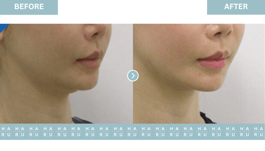 Before and After Double Chin Thread Lift