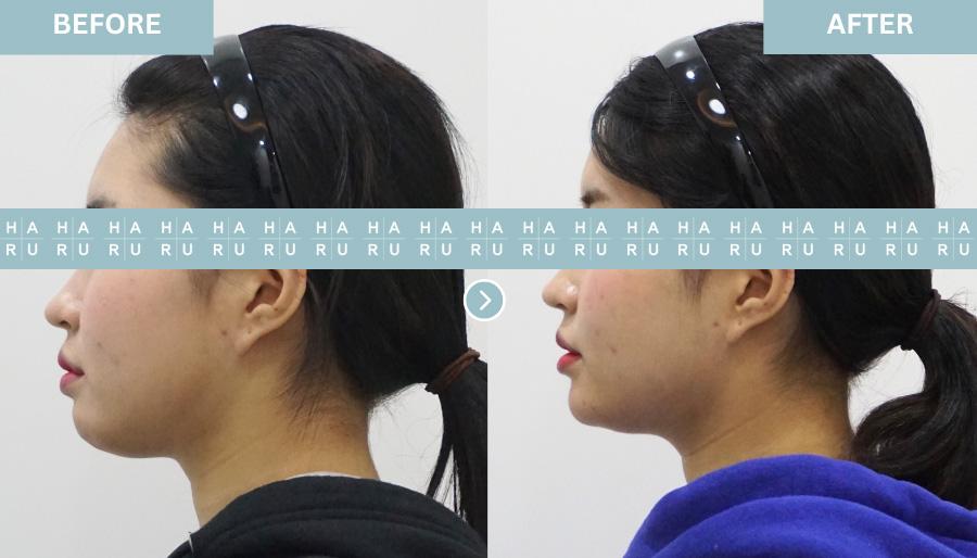 Before and After Chin Botox