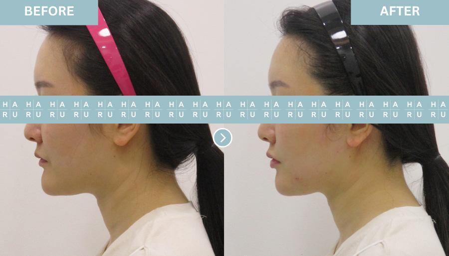 Before and After Lip Fillers