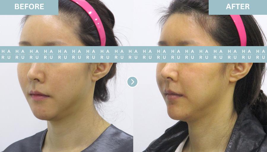 Before and After Chin Botox