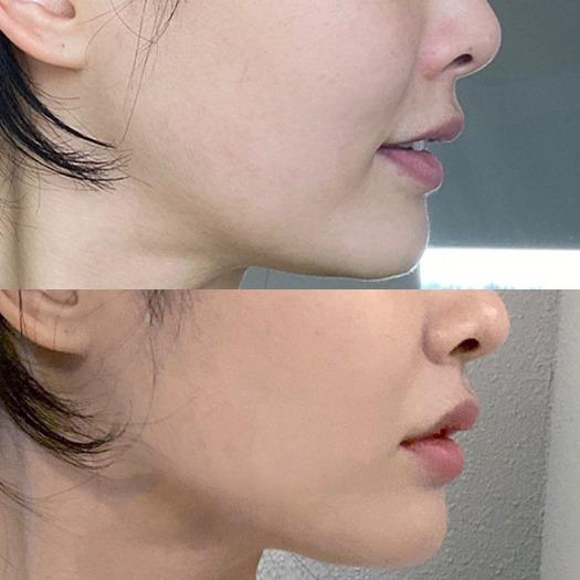Before and After Fat Dissolving Injection