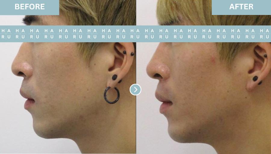 Before and After Hiko Nose Thread Lift