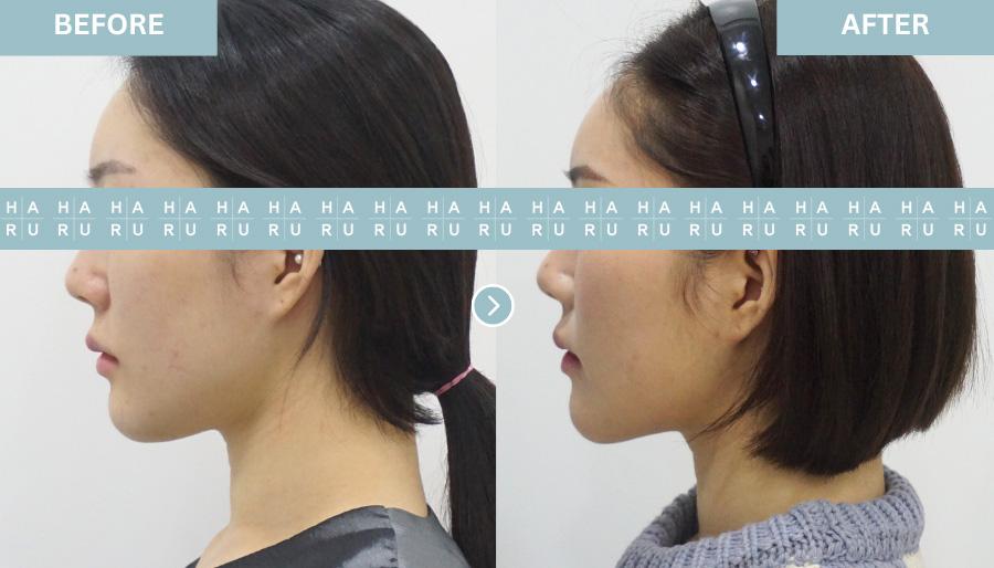 Before and After Face Thread Lift