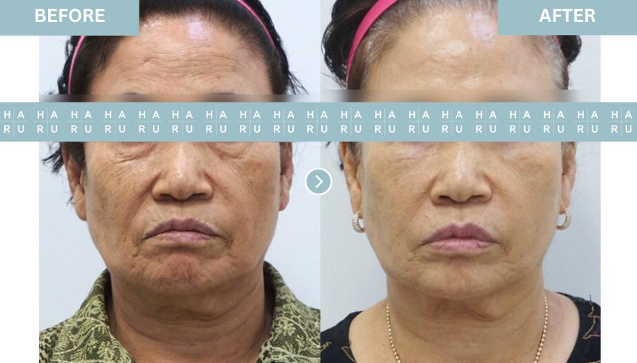 Before and After Collagen Filler