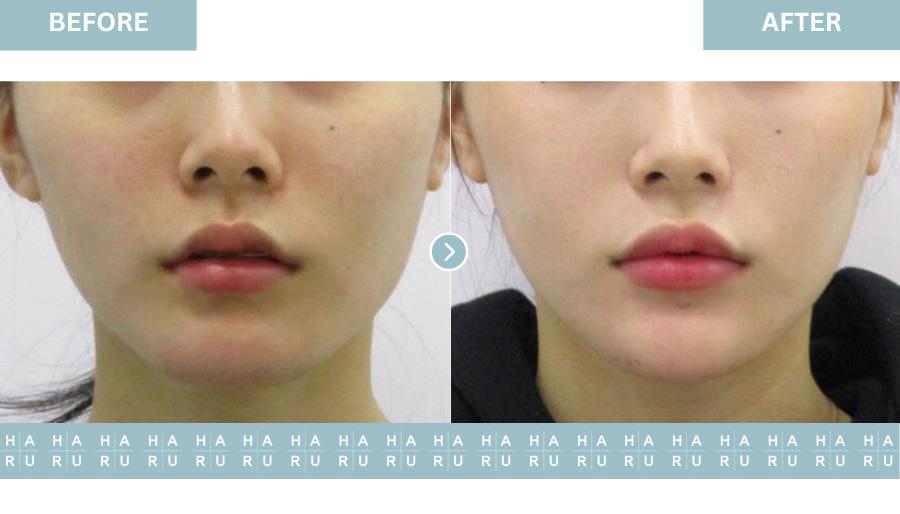 Before and After Chin Botox