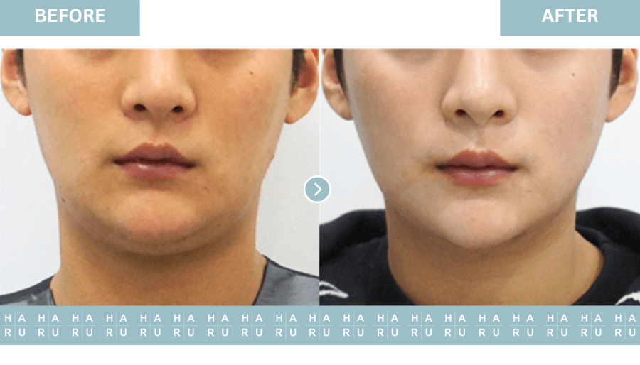 Before and After Face Thread Lift