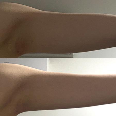 Before and After Fat Dissolving Injection
