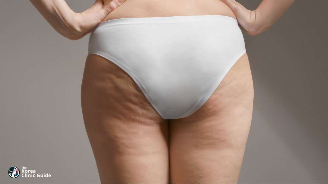 Eigenfetttransfer bei Hip Dips in Korea (Seoul | beste Kliniken, Kosten, Verfahrensarten und mehr)