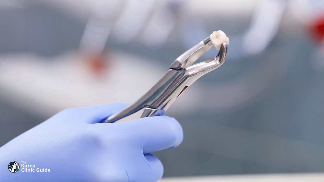 Inlay-Füllungen in Korea | Die besten Kliniken, Kosten, Behandlungsoptionen und mehr