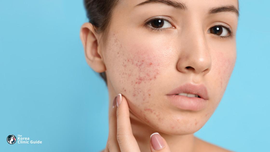 Acne Scar Treatment in Korea | Costs, Procedure Types, Candidacy & Recovery